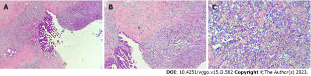 Postoperative pathological examination revealed carcinosarcoma of the common bile duct with a tumor volume of 1.0 cm × 0.6 cm × 0.6 cm. Cancerous tissue accounted for 40% and sarcoma for 60% of the tissue. A: Heterotypic glands can be seen in the mucosa of the bile duct, and infiltrating growth can be seen. Adenocarcinoma can be seen in the muscle wall of the bile duct; B: The muscle wall stroma of bile duct can be composed of heterotypic large cells, epithelial cancer nests and sarcoma-like components; C: Sarcoma-like area, large nuclear heterotypic cells in various forms and pathological mitotic image can be seen.