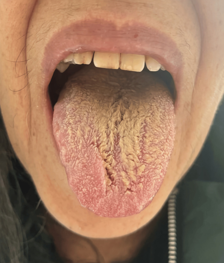 Black hairy tongue five days after complete discontinuation of olanzapine.Consent for publishing the image was obtained from the patient.
