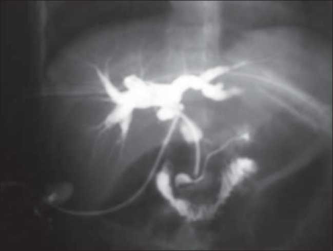 T-tube cholangiogram showing pancreatic duct, intrahepatic bile ducts, and duodenum