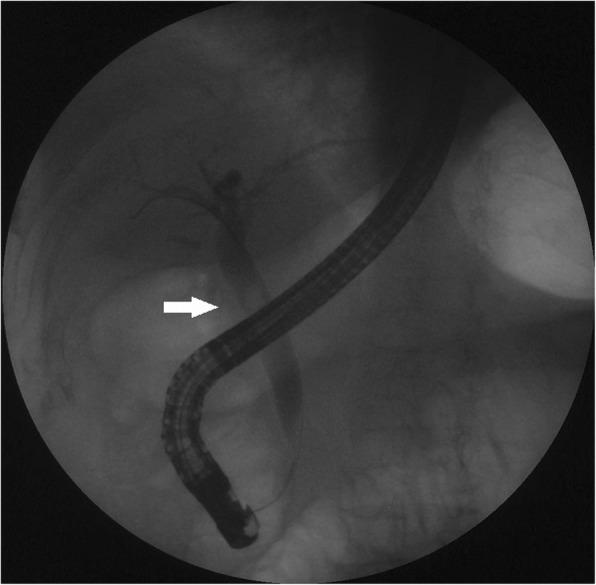 An ERCP revealed a dilated common bile duct with a round filling defect (arrow)