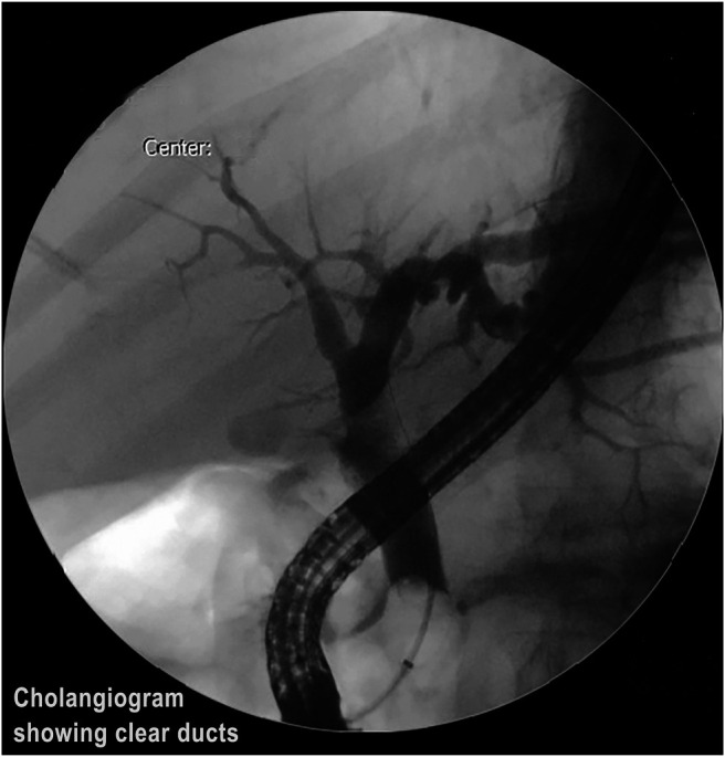 Occlusion cholangiogram showing clearance of bile ducts.
