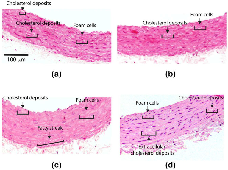Illustrative images showing atherosclerotic lesions after of the treatment with ZnONPs: (a) control or healthy rat, (b) ZnONPs-1 month treated rat, (c) ZnONPs-2 months treated rat, and (d) ZnONPs-3 months treated rat. All images were acquired with 10× magnification.
