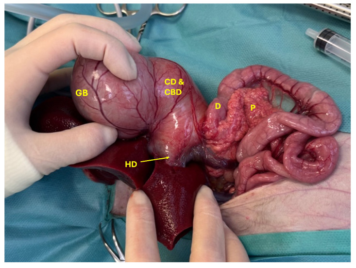Dilated gallbladder (GB) with enlarged cystic and common bile duct (CD and CBD) entering into the duodenum (D), severely enlarged hepatic duct (HD), and severely inflamed pancreas (P).