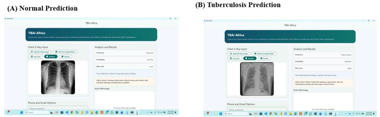 The screenshots from the deployed tuberculosis screening system demonstrating classification results for both Normal and Tuberculosis chest radiographs. Panel (A) shows a Normal prediction with low tuberculosis probability and low risk level, along with the uploaded chest radiograph, prediction result, probability score, and clinical recommendation. Panel (B) shows a Tuberculosis prediction with high probability and high risk level, including a recommendation for clinical review and confirmatory testing. These examples demonstrate the deployed system’s ability to provide classification results, risk stratification, and decision-support guidance on both desktop and mobile platforms.