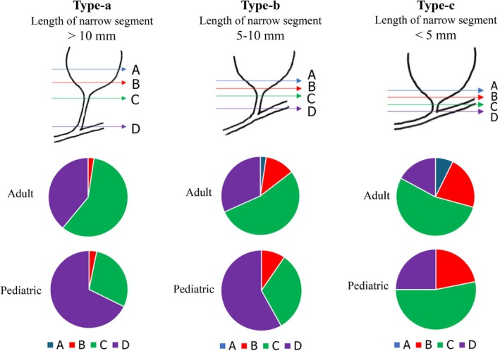 Results of the nationwide expert survey of adult and pediatric institutions on the duodenal‐side transection line in cystic‐type CBD according to the length of the narrow segment. The length of the narrow segment is categorized into the following three types: Type‐a, > 10 mm; Type‐b, 5–10 mm; Type‐c, < 5 mm. The transection lines were categorized as A–D: A (blue line), upper dilated portion; B (red line), lower dilated portion; C (green line), upper narrow segment; and D (purple line), lower narrow segment (near the confluence of the pancreaticobiliary junction).