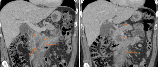 A 62-year-old male presenting with abdominal pain. Coronal computed tomography images show low-density necrosis (thin short arrow) within tumor (thin long arrow), which infiltrates the mesenteric root without occlusion of mesenteric vessels. There is a collection extending from the third part of the duodenum into tumor (thick arrow) suggesting fistula from probable erosion of duodenal wall. Mild pancreatic duct dilation is seen (arrowhead).