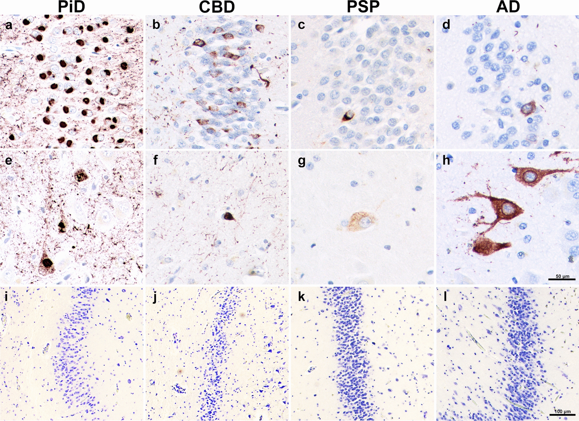 Tau-positive Pathology and Neurons in Aphasic Dementia. (a–d) Granule cell tau pathology visualized through AT8 immunohistochemical staining. (e–h) Hilar tau pathology revealed through AT8 immunohistochemical staining. (i–l) Granule neuronal density revealed through histochemical staining with cresyl violet. (a, e, i) was taken from case PiD 7, (b, f, j) was taken from CBD 6, (c, g, k) was taken from PSP 4, and (d, h, l) was taken from PPA-AD 3. PiD images show intense tau neuropathologic burden in both granule (a) and hilar (e) cells. CBD images show greater neuropathologic inclusions in granule cells (b), while PPA-AD has more inclusions in the hilar region (h). PSP shows uniformly sparse pathology (c, g). While PSP and AD show relatively preserved neuronal densities (k, l), there is no significant difference between neuronal densities across tauopathies. Scale bar = 50 µm in h, and applies to a–g. Scale bar = 100 µm in l, and applies to i–k