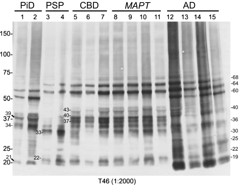 Immunoblot analysis of sarkosyl-insoluble tau in tauopathies. Hyperphosphorylated full-length tau (60, 64 and 68 kDa), various C-terminal fragments and smears were detected in the sarkosyl-insoluble fractions of tauopathy brains by T46 (anti-tau C-terminus). The banding patterns are characteristic for each disease, although the patterns of fragments of CBD and MAPT (intron mutation) seem very similar