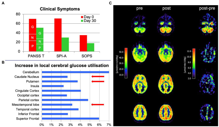 Effects of treatment with 600 mg oral cannabidiol per day in a 19-year-old male with clinically high mental risk before (pre) and on day 30 (post). (A) Positive and Negative Symptoms Scale (PANSS; P: Positive, N: Negative, G: General subscore segments marked by respective letters), the Schizophrenia Proneness Instrument - Adult (SPI-A) and the Structured Interview for Prodromal Syndromes (SIPS) before (red bars) and after (green bars) treatment. Significant clinical improvement was observed, reflected by the substantial reduction in scale scores. (B) FDG positron emission tomography scans of the brain before (pre) and after treatment (post) and the difference between post- and pre-treatment. (C) Increase in local cerebral glucose utilization after treatment in specific brain regions (in %). Brain regions (striatum, medial temporal cortex and midbrain) previously reported to be functionally modulated in CHR individuals by a single oral dose of 600 mg cannabidiol in a functional MRI study (11) are highlighted by red arrows.