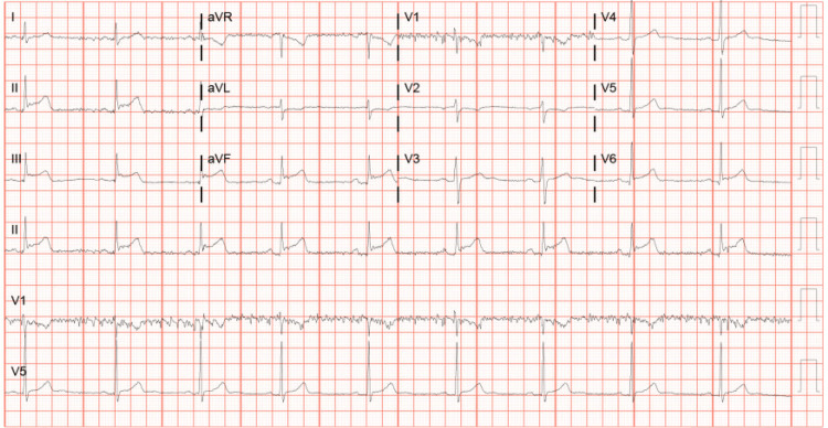 EKG showing ST-segment elevations in leads II, III, and aVF and T-wave inversions in aVLEKG: electrocardiogram