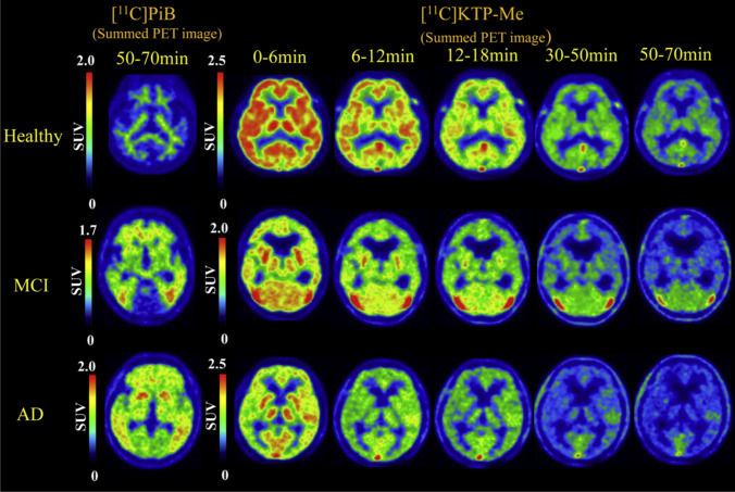 Comparison of [11C]PIB and [11C]KTP-Me in Alzheimer’s disease. Reprinted from “Exploratory human PET study of the effectiveness of 11C-ketoprofen methyl ester, a potential biomarker of neuroinflammatory processes in Alzheimer's disease”, volume 43, Ohnishi A, Senda M, Yamane T, Mikami T, Nishida H, Nishio T, et al. Nuclear Medicine and Biology, 438-444, Copyright (2016), with permission from Elsevier