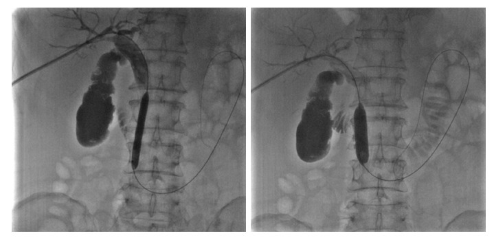 Sequential dilation of the sphincter of Oddi with an 8 mm × 60 mm and a 14 mm × 40 mm balloon.