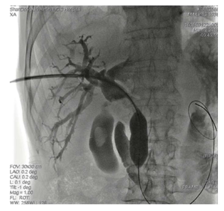 Dilatation of the sphincter of Oddi with a balloon catheter was performed.