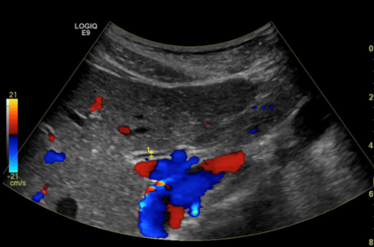 Ultrasound of the right upper quadrant (RUQ) reveals no dilation to the common bile duct, which measures 5 mm.