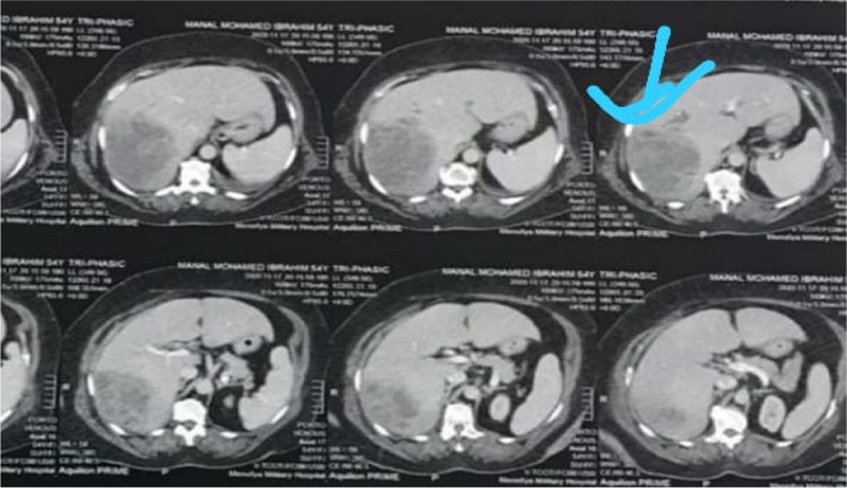 A large right lobe liver abscess with a potential biliary linkage in a biliary-cut