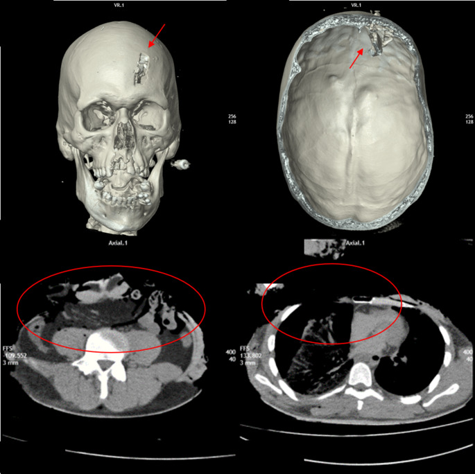 Clockwise: Depressed skull injury from impact against a protruding portion of an obstacle (red arrows), followed by the creation of electric arc burns and extensive subsequent carbonization of the body, with large areas of continuous injury on the right anterior thoracic and bilateral abdominal regions (red circles)