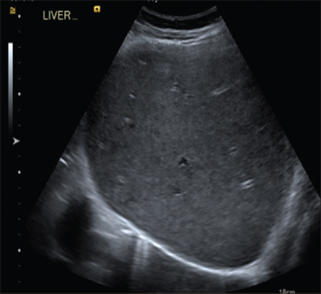Ultrasound showing normal liver size with diffuse increase echogenicity keeping with diffuse fatty infiltration with no focal lesions or masses
