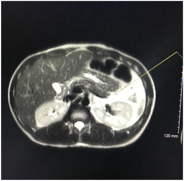 T2-weighted computed tomography scan of the pancreas demonstrates a large amount of peripancreatic (marked with yellow arrow) and left upper quadrant fluid that can be correlated clinically with acute pancreatitis.