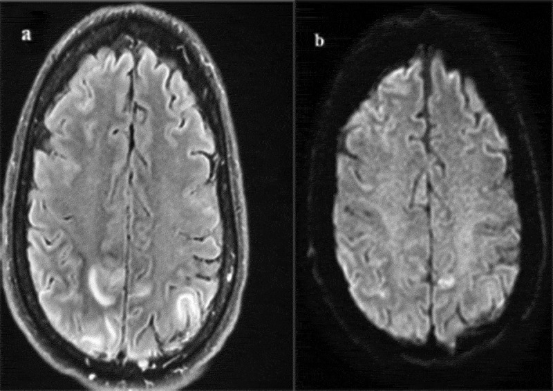 MRI of the brain, Axial view, revealing Posterior reversible encephalopathy syndrome. (a) T2 FLAIR: hyperintensity in the parietal lobes. (b) Diffusion-weighted sequence: diffusion restriction in the parietal lobes.