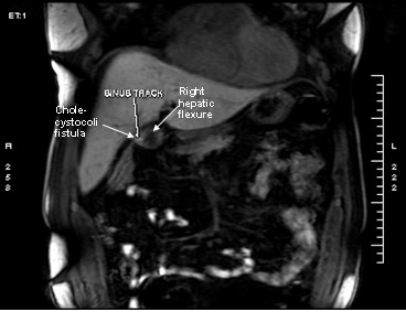MRI:T1 and T2 weighed images with iv contrast Gadolinium- Bopta, revealing fistulous tract between the right colonic flexure and gallbladder (cholecystocolic fistula) and a large gallstone (2 cm).