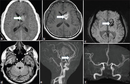 (a) Computed tomography showing hematoma in left caudate nucleus with intraventricular extension. (b and c) magnetic resonance imaging (MRI) showed subacute hematoma in left caudate nucleus. (d) T2 FLAIR image showing bilateral normal abducens nuclei. (e) MR Angiogram showing constriction in bilateral anterior cerebral arteries. (f) Normal MR Angiogram of intracranial vessels at 4 weeks of follow-up