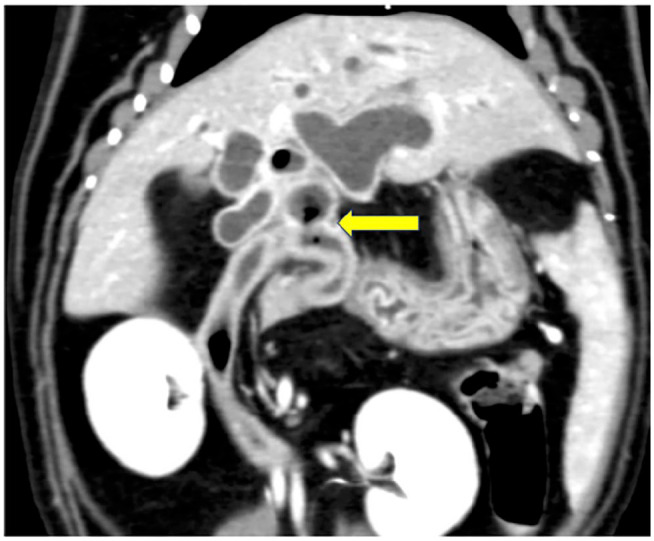 Coronal view of abdominal CT scan 6 months postoperatively. Digestive gas was visible in the common bile duct and extrahepatic bile duct. The yellow arrow indicates the junction of the common bile duct and duodenum