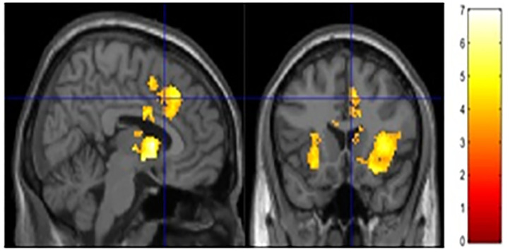 Risk activity collapsed across groups. Significant activity was observed in the ACC, NAc and bilateral insula.