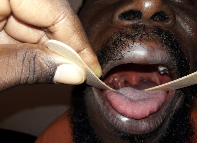 Oropharyngoscopie à l'abaisse-langue, contrôle de la région amygdalienne droite, évolution locale satisfaisante après 3 semainesOropharyngoscopy with tongue depressor, control of the right tonsil area, satisfactory local evolution after 3 weeks
