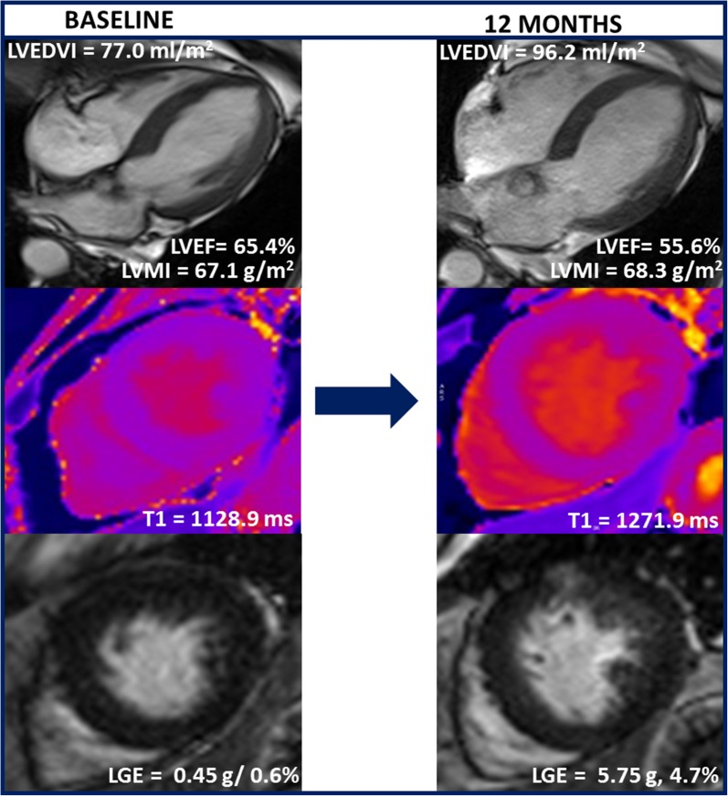 Short-term adverse cardiac remodeling in asymptomatic moderate and severe aortic stenosis by cardiovascular magnetic resonance. A representative patient undergoing cardiovascular magnetic resonance at baseline at 12-month follow-up. There is a progressive increase in left ventricular end-diastolic volume (LVEDV) and left ventricular mass index (LVMI), reduction in left ventricular ejection fraction (LVEF) and increases in myocardial fibrosis by both native T1 mapping and late gadolinium enhancement (LGE) in the interval of 12 months, whereas the indexed aortic valve area remained unchanged. These changes suggest adverse cardiac remodeling despite no further reduction in indexed aortic valve area.Reproduced with permission from Singh et al13