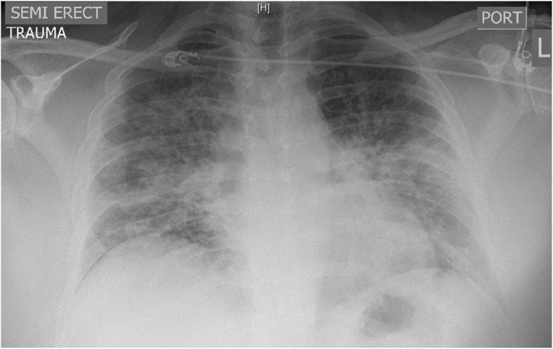 Chest XRay of a patient with EVALI Showing bilateral patchy opacities