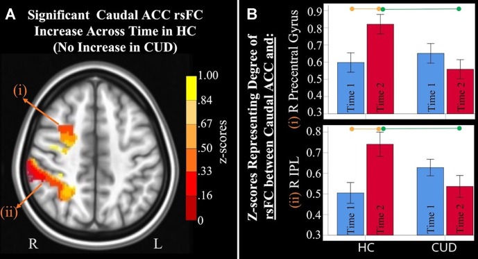Significant interaction effects of caudal anterior cingulate cortex (ACC) resting-state functional connectivity (rsFC) identified by a 2 × 2 mixed-model analysis controlling for alcohol and nicotine. (A) LEFT: Axial MNI (Montreal Neurological Institute) brain slice (z = 46) displaying two clusters that showed a significant group × time interaction in resting-state functional connectivity (rsFC) between the caudal anterior cingulate cortex (ACC) seed and: (i) right (R) precentral gyrus (F = 9.467, p = 0.004; Brodmann area 6; 471 voxels) and (ii) R inferior parietal lobule (F = 8.348, p = 0.006; Brodmann area 7; 1,900 voxels). (B) RIGHT: Orange lines above HC bar graphs show significant post hoc comparisons in which healthy controls (HC) had significant rsFC increases from Time 1 (blue bars) to Time 2 (red bars) between caudal ACC and (i) right precentral gyrus (F = 9.983, p = 0.006) and (ii) right IPL (F = 13.505, p = 0.002). Individuals with cannabis use disorder (CUD), however, did not show any change in rsFC across time between these regions. Green lines between red bars show significantly lower rsFC in CUD than HC at Time 2 between caudal ACC and (i) right precentral gyrus (F = 4.992, p = 0.031) and (ii) right inferior parietal lobule (F = 4.568, p = 0.039).