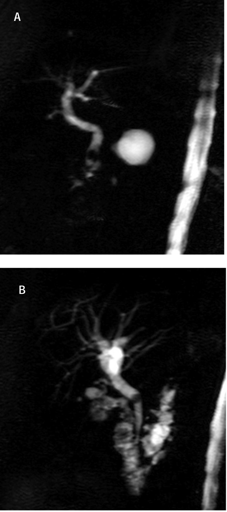 MRCP - pacient with cholecystectomy; calculus cholodoc (a) calculus with dilation of biliary tree (b)