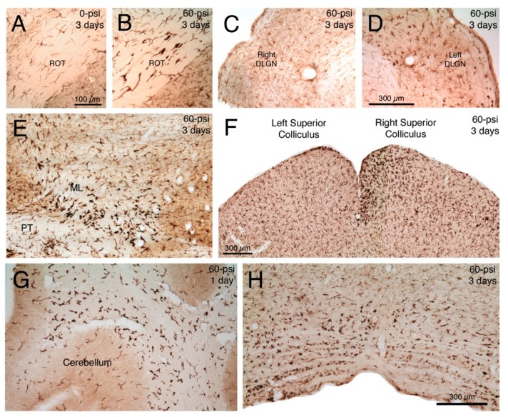 Transverse sections immunostained for ionized calcium-binding adapter molecule-1 (IBA1), showing: Normal microglia in right optic tract (ROT) three days after a left cranial 0-psi blast (A); activated microglia in the ROT three days after a left cranial 60-psi blast (B); normal microglia in left dorsal lateral geniculate nucleus (DLGN) three days after a left cranial 60-psi blast (C); activated microglia in the right DLGN three days after the same left cranial 60-psi blast (D); activated microglia in the left medial lemniscus (ML) and pyramidal tract (PT) at the level of the mesencephalon three days after left cranial 60-psi blast (E); normal microglia in left superior colliculus and activated microglia (especially medially in the upper layers) in the right superior colliculus three days after a left cranial 60-psi blast (F); activated microglia in the deep cerebellar white matter one day after left cranial 60-psi blast (G); and activated microglia in basal medulla three days after a left cranial 60-psi blast, particularly on the left side (H). Note that normal microglia (A,C) immunolabel lightly for IBA1, and have a small cell body and thin processes. By contrast activated microglia immunolabel intensely for IBA1, and have more prominent perikarya that possess thick short processes. Images A and B are at the same magnification as one another, images C and D are at the same magnification as one another, and images E, G and H are at the same magnification as one another.