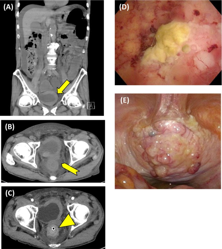 Abdominal CT revealed a bladder tumor extending from the dome to the left lateral wall, with suspected muscle invasion and left hydronephrosis (A, arrow), along with increased perirectal fat density, rectal wall thickening causing obstruction, and ascites (B, arrowhead). Contrast‐enhanced CT on hospital day 3 revealed the rectal wall alternating hypo‐ and hyperenhancement (C, triangle). Cystoscopy showed a partially necrotic mass predominantly involving the bladder dome (D). Tumor invasion extending to the peritoneum was apparent (E).
