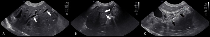 Post‐operative ultrasound images for Case 1. (A)—Right liver with persistently dilated intrahepatic ducts (white arrows). (B)—Left liver with resolution of intrahepatic duct dilation (white arrows). (C)—Stent in place across the CBD (black arrows).
