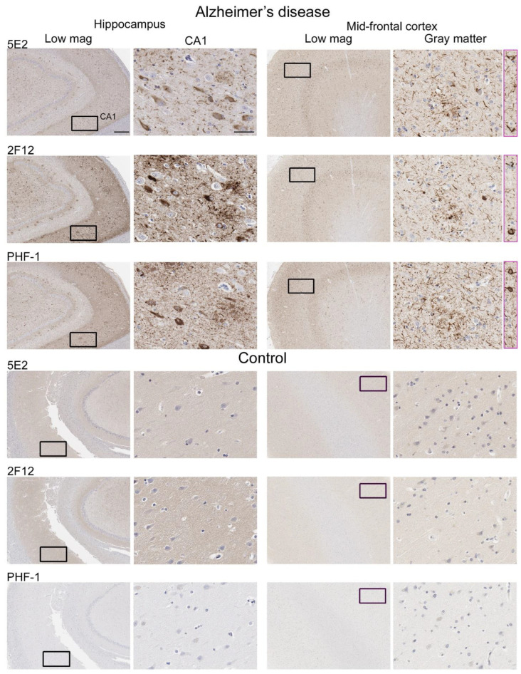 Immunohistochemical labelling of tau neuropathology in Alzheimer’s disease brain tissue using novel antibodies 5E2 and 2F12. Hippocampus and mid-frontal cortex were investigated in both Alzheimer’s disease and control brain tissue using novel antibodies 5E2 and 2F12, as well as phospho-dependent (pS396/pS404) tau antibody PHF-1. For AD cases, hippocampal tissue from case AD-8 and mid-frontal cortex tissue from case AD-5 are shown. For control cases, hippocampal tissue from case control-8 and mid-frontal cortex tissue from control-3 is shown. Low-magnification images of CA1 within the hippocampus and gray matter of the mid-frontal cortex are indicated. Black boxes in low-magnification images indicate general area in which the high-magnification image is from, high magnification images were cropped from the larger image where black box is located. Pink boxes are from different areas within corresponding low-magnification images. Scale bar for high-magnification images is 50 µm. Scale bar for low-magnification images is 500 µm.