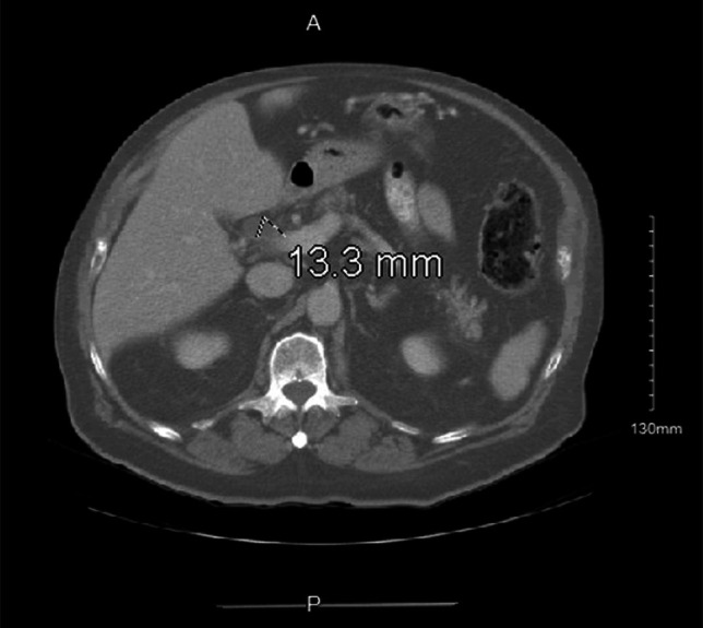CT of abdomen and pelvis with IV and oral contrast depicting dilated CBD to 1.3 cm with an abrupt caliber change and concern for wall thickening. CBD, common bile duct; CT, computed tomography; IV, intravenous.