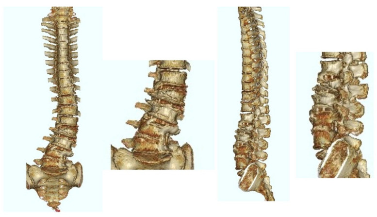 Postoperative 3D CT image of the same patient as in Figure 5. The patient underwent LLIF at L1/2, L2/3, and L3/4 using PEEK cages.