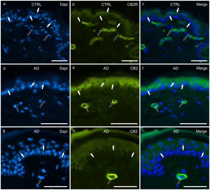 Photomicrographs of cryosections of canine skin showing cannabinoid receptor 2 (CB2R) immunoreactivity (IR) in the tissues of the healthy dogs (CTRL) (a–c) and in the dogs with atopic dermatitis (AD) (d–i). (a–c) The white arrows indicate the DAPI-labeled nuclei of the keratinocytes showing moderate CB2R-IR of the cytoplasm and cell membrane. The open arrows indicate the DAPI-labeled nuclei of vascular endothelial cells of the dermis showing bright CB2R-IR. (d–i) The white arrows indicate the DAPI-labeled nuclei of the keratinocytes of the dogs with AD showing bright CB2R-IR. The open arrows indicate the DAPI-labeled nuclei of the vascular endothelial cells of the dermis showing bright CB2R-IR. Bar, 50 μm.