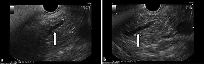 a, b EUS images showing an abnormal pancreatic duct at the neck through the head of the pancreas, suggesting pancreas divisum.