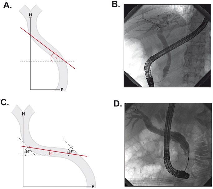 Characterisation of the oblique common bile duct syndrome.Schematics (A,C) and radiographs (B,D) depict the morphology of “normal” (A,B) and “oblique” bile ducts (C,D). Angle α was defined as the angle enclosed between the horizontal portion of the bile duct and the horizontal plane. H, porta hepatis; P, papilla Vateri.