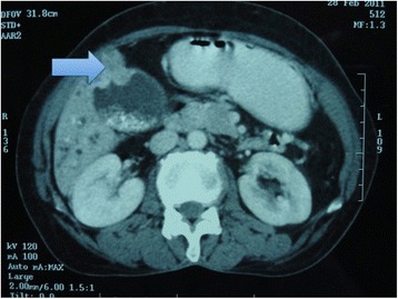 CECT of the abdomen showing thickening of the gall bladder wall at the fundus and multiple gallstones