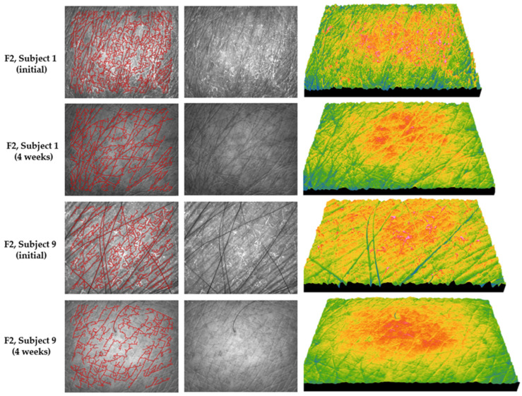 Representative images of skin topography recorded for formula F2 in subject no. 1 (age 87) and subject no. 9 (age 67) at baseline and after 4 weeks of treatment; the images include the wrinkle line map (left), grayscale images of the skin surface (middle), and 3D images of the skin microrelief (right).