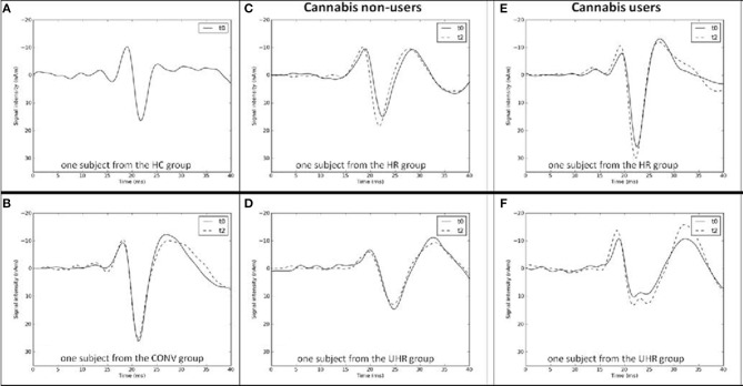 Examples of N20 curves at baseline (t0) and at follow-up (t2) from the (A) healthy control (HC), (B) converter (CONV), (C) high-risk (HR) cannabis non-users, (D) ultra-high-risk (UHR) cannabis non-users, (E) high-risk (HR) cannabis users, and (F) ultra-high-risk (UHR) cannabis users groups.