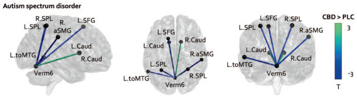 Drug effects on functional connectivity of cerebellar vermis VI in the ASD group (cannabidiol > placebo). T-values (T) of edges, as indicated by colour bar, are corrected for multiple comparisons at connection- and seed-level (p = 0.05 and pFDR = 0.05, respectively). Abbreviations – ASD: autism spectrum disorder; CBD: cannabidiol; L.Caud: left caudate; L.SFG: left superior frontal gyrus; L.SPL: left superior parietal lobe; L.toMTG: left middle temporal gyrus (temporo-occipital part); R.aSMG: right anterior supramarginal gyrus; R.Caud: right caudate; R.SPL: right superior parietal lobe; PLC: placebo; Verm6: cerebellar vermis VI.