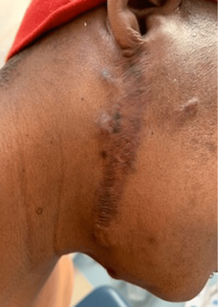 Keloid scar on the neck