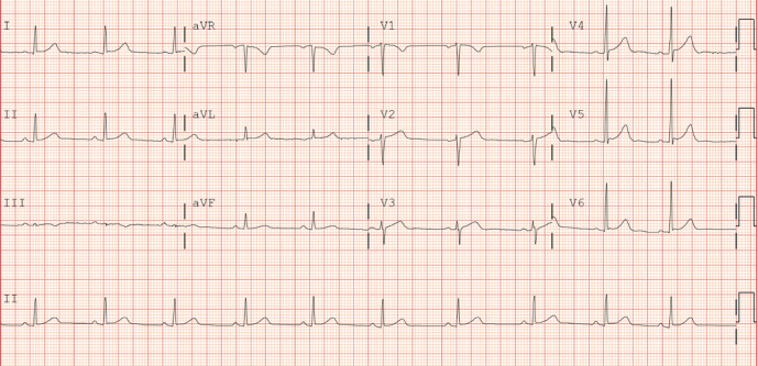 ECG two days after admission demonstrating absence of characteristic Brugada pattern.