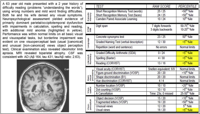 Case study of a PCA patient presenting with “nonvisual” symptoms. Abbreviation: PCA, posterior cortical atrophy.