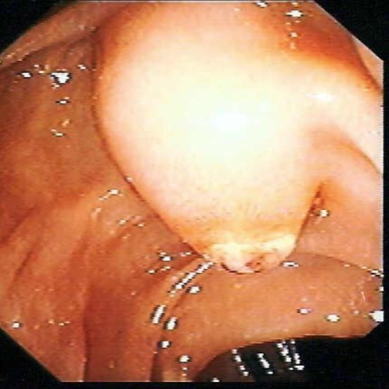 A prominent papilla obstructed by sludge in a 63 year-old female patient. Successful intubation with the papillotoma was performed after 300 s.