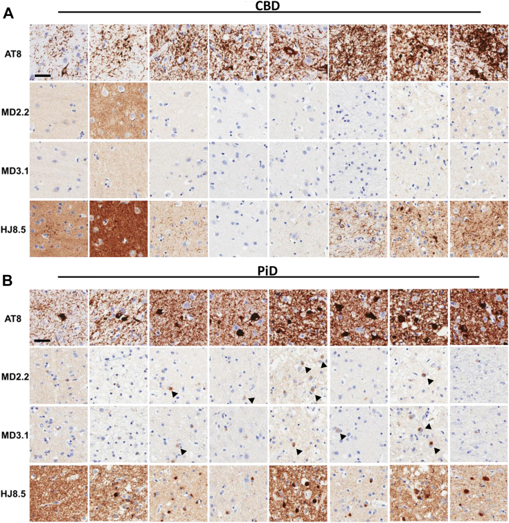 MD2.2 and MD3.1 staining of CBD and PiD brains. Representative images of tissue microarray IHC staining of fixed frontal cortex of eight CBD brains (A) and eight Pick disease brains (B). CBD brain exhibited no significant tau staining above background. In PiD there was faint labeling of Pick bodies (arrowheads). This contrasted with staining by AT8 and HJ8.5. Scale bar = 50 μm.
